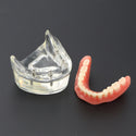 1Pc Dental Teeth Study Model Overdenture Inferior 4 Implant Demo Model 6002 02